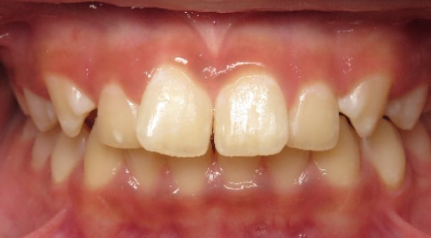 Before orthodontic treatment – patient smile at Sunflower Orthodontics, Mansfield TX