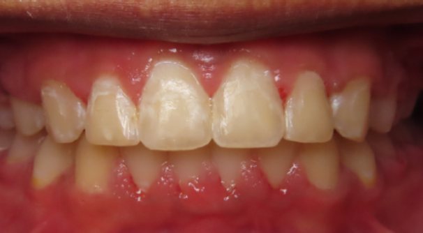 After orthodontic treatment – smile transformation at Sunflower Orthodontics in Mansfield, TX
